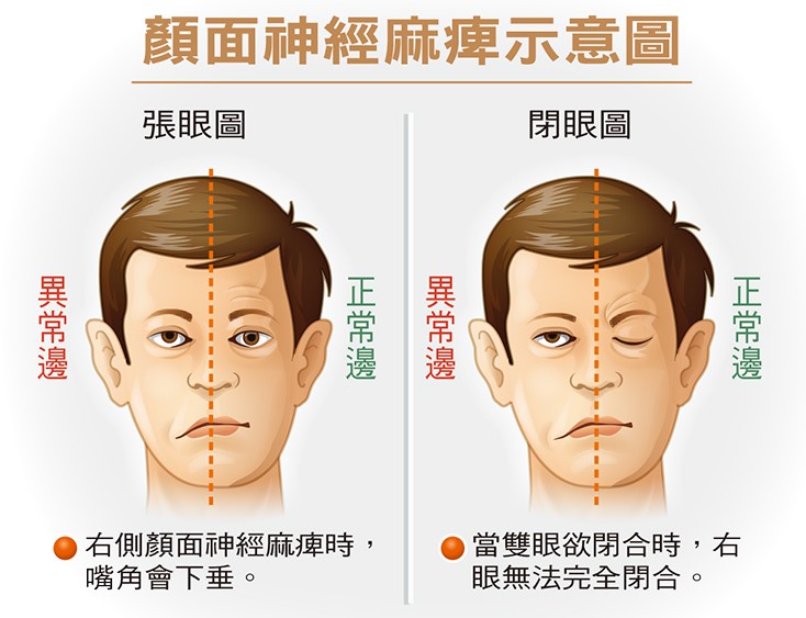 嘴歪臉斜不一定是中風！當心也可能是顏面神經麻痺！
